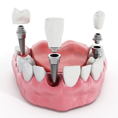 牙龈萎缩可以种植牙吗