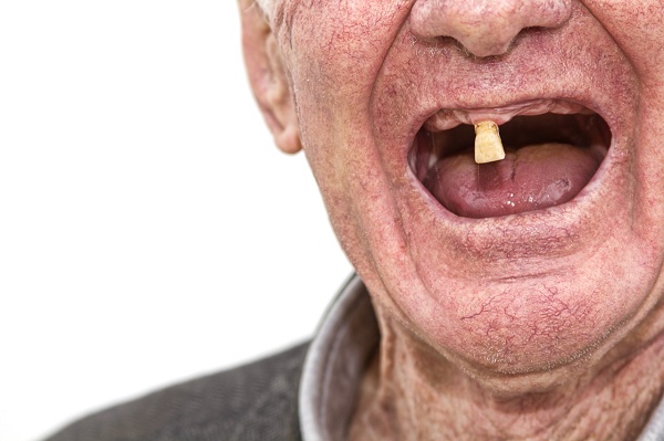 老年人做种植牙有哪些好处?深圳种植牙医生推荐?